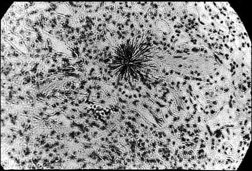 hot-particle-lung-tissue19972.jpg