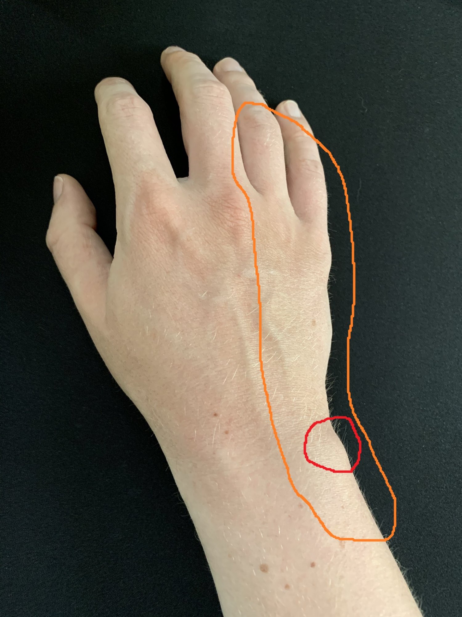 Dupuytren's Disease - Dupuytren's Contracture - OrthoInfo - AAOS